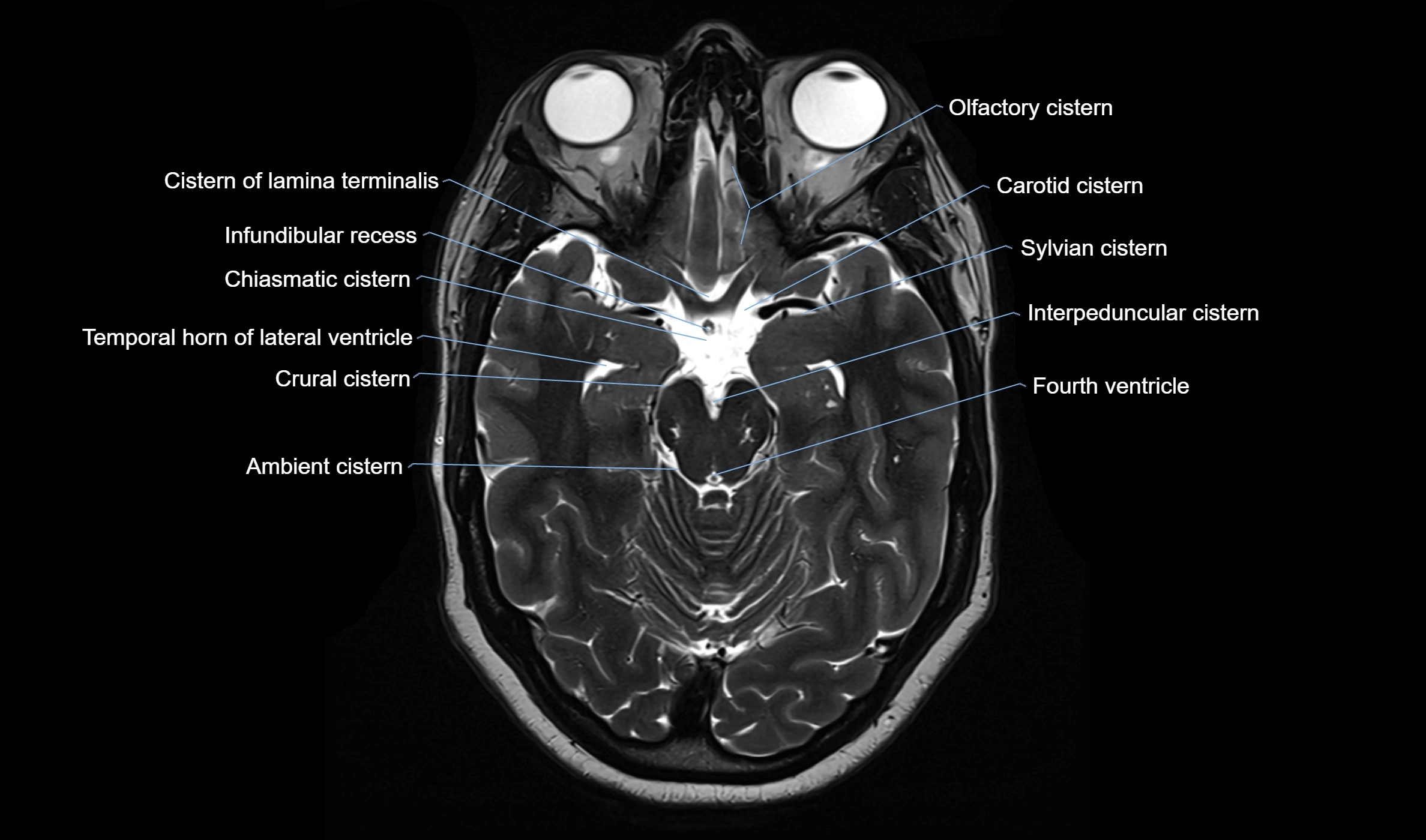 Brain cisterns  and ventricles  axial anatomy 3T MRI image-img-00001-00020.webp